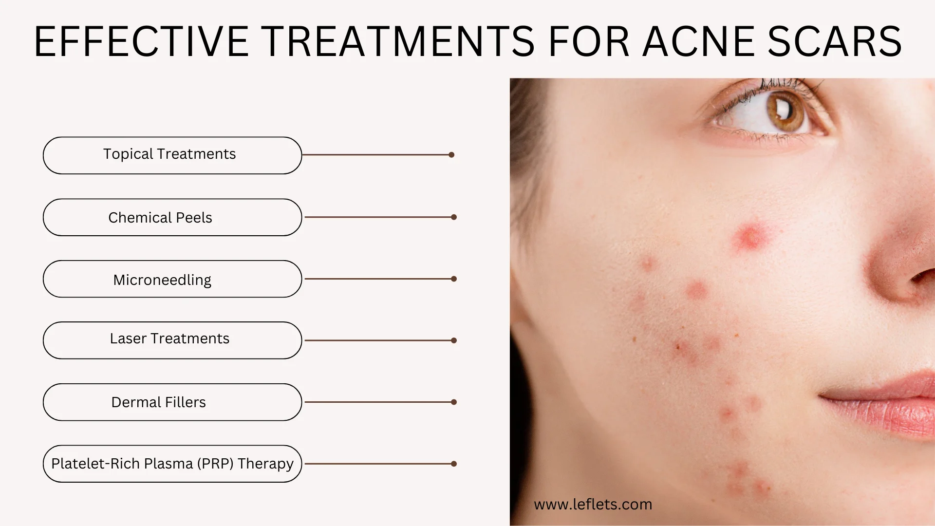 Effective Treatments for Acne scars 2024